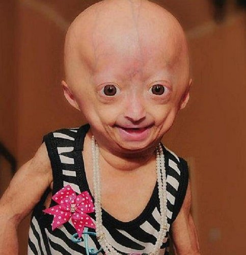 Adalia Rose Kindheitsfoto