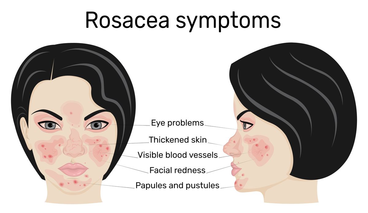 hudvårdsrutin för rosacea